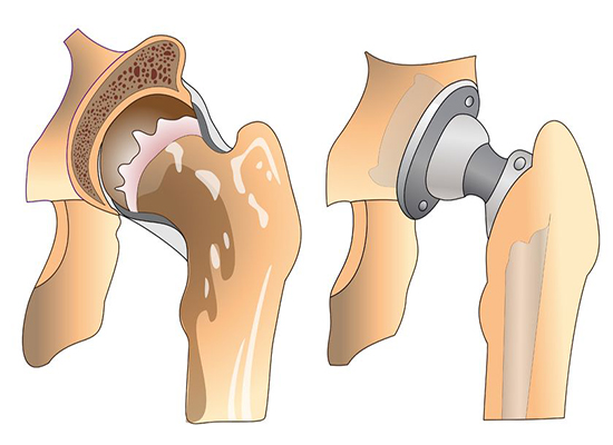 Replacement Arthroplasty - When is Joint Replacement Su