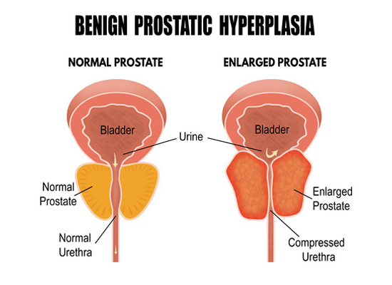 Why Do We Have Prostate Issues As We Age?